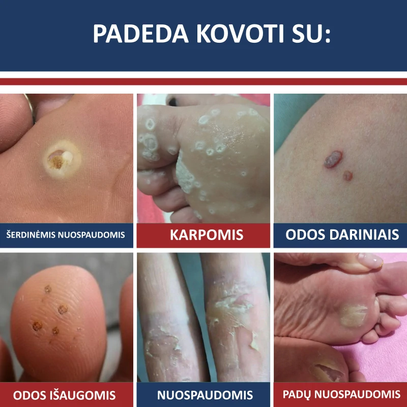 Pleistrai nuo Karpų ir Nuospaudų - Image 4